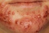 conglobata, acne conglobata, acne, que es acne, como se quita el acne