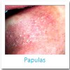 Acne Vulgar, Acne Vulgaris, que hace un dermatologo, imagenes de acne, por que sale el acne, tipos de acne