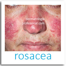 rosacea, como eliminar el acne, acne, que es acne, tipos de acne