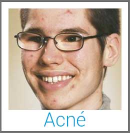 tratamiento para acne